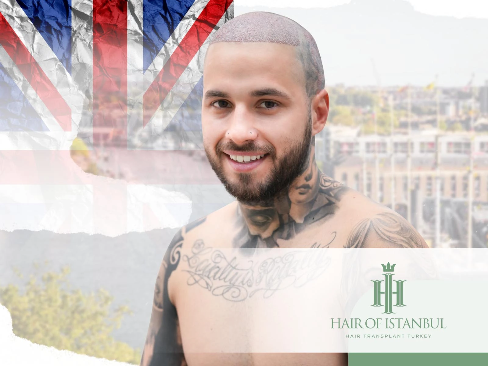 FUE Hair Transplant Bristol: Best Clinics and Results Explained