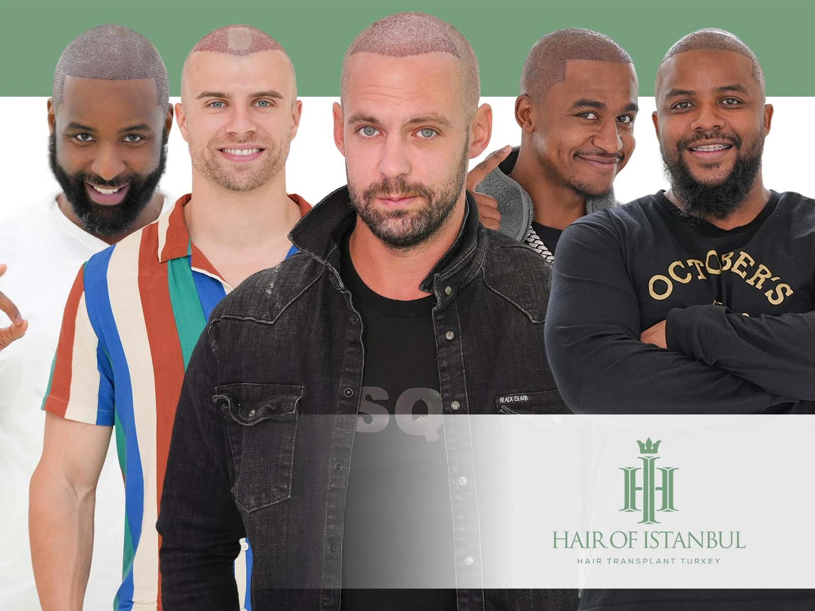 Hair Implants: The Complete Guide to Natural Hair Restoration