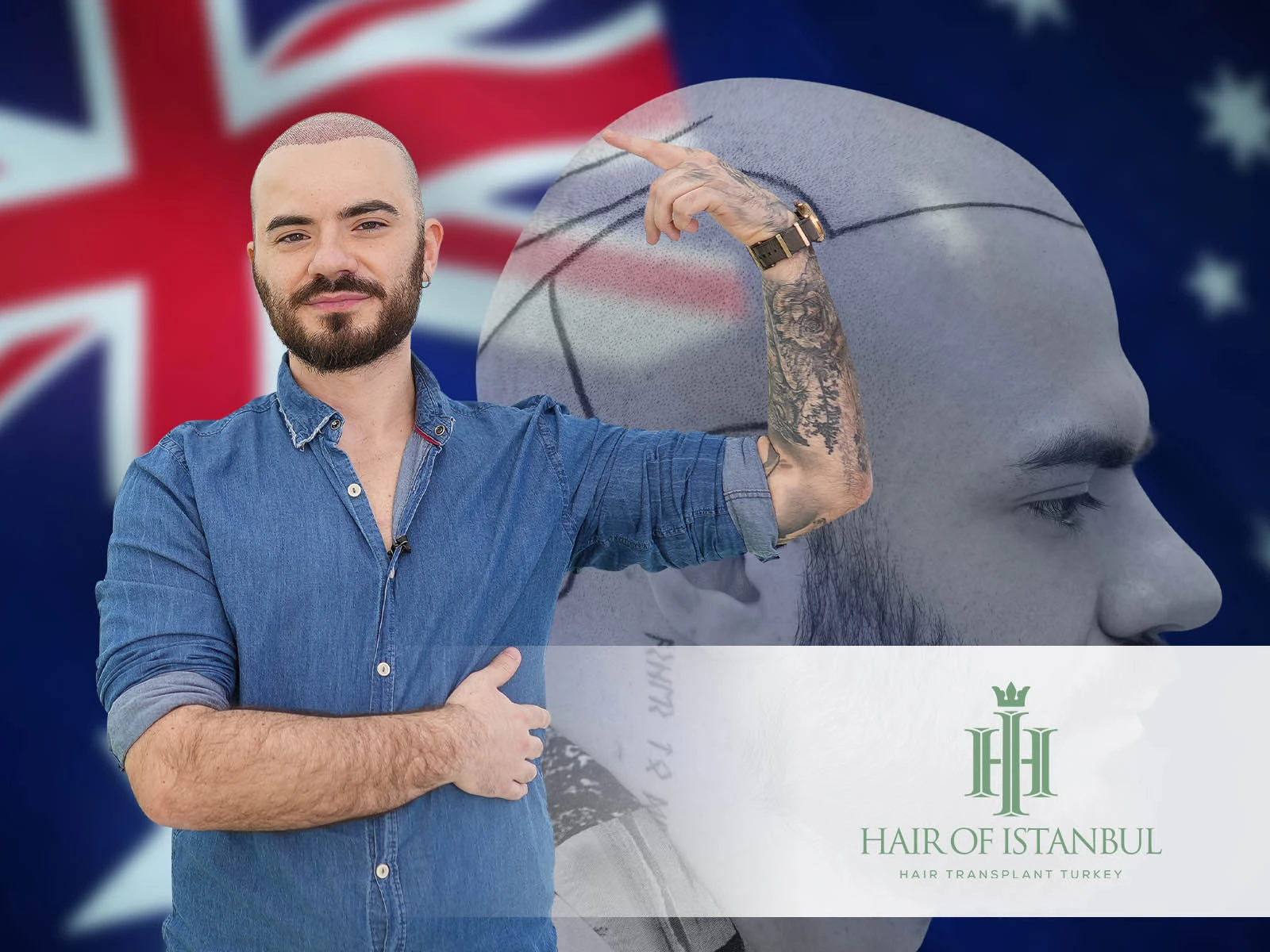 Hair Transplant Australia: Why Istanbul Outperforms Local Options