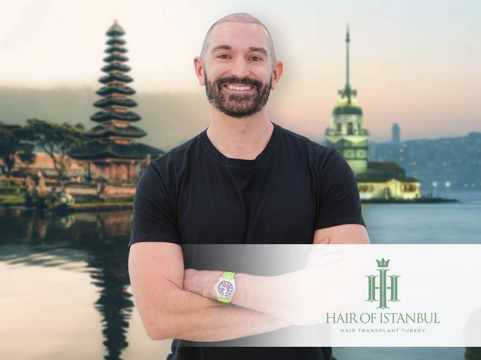Hair Transplant Bali vs Istanbul: Choosing the Right Destination for Natural Results