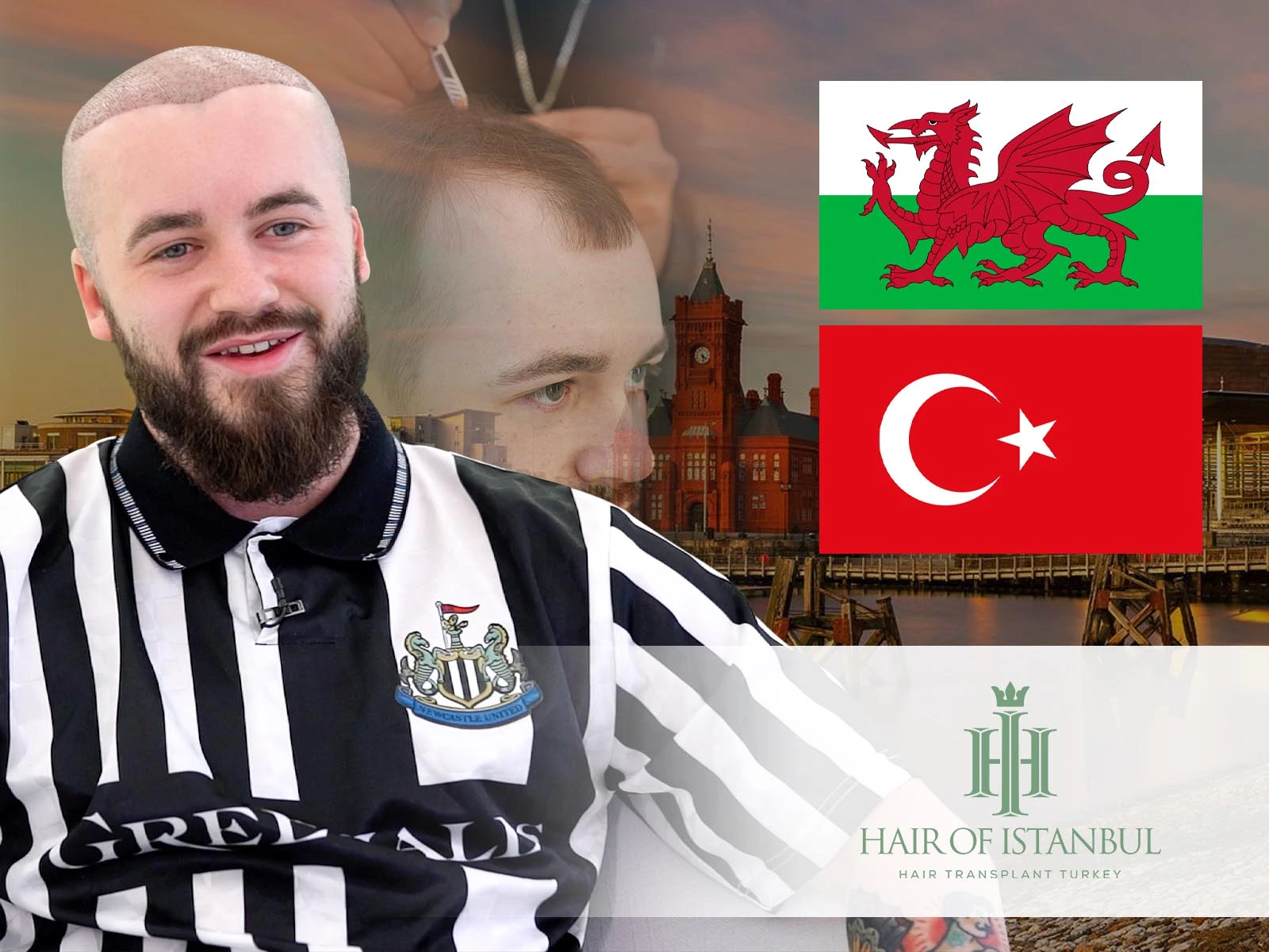 Hair Transplant Cardiff or Turkey? Why Hair of Istanbul Wins
