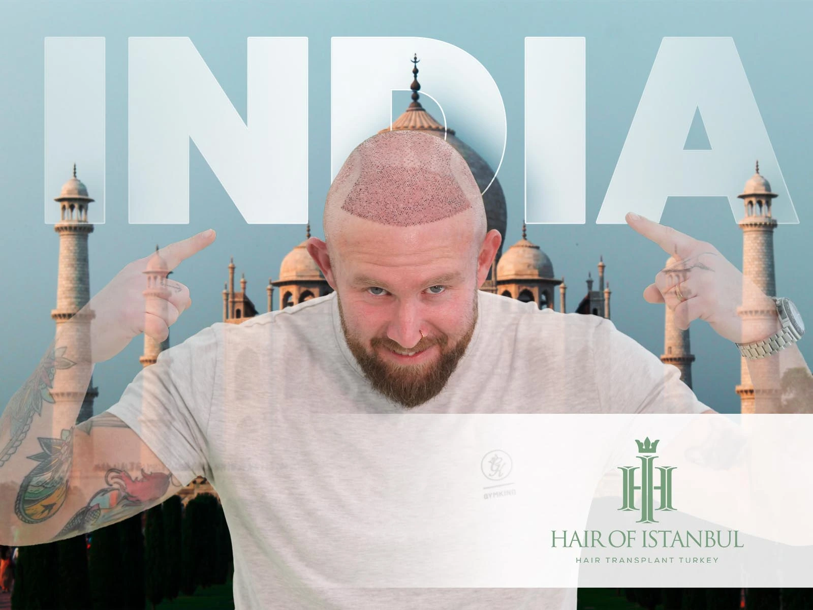Hair Transplant India: How Turkey Has Set a Higher Standard