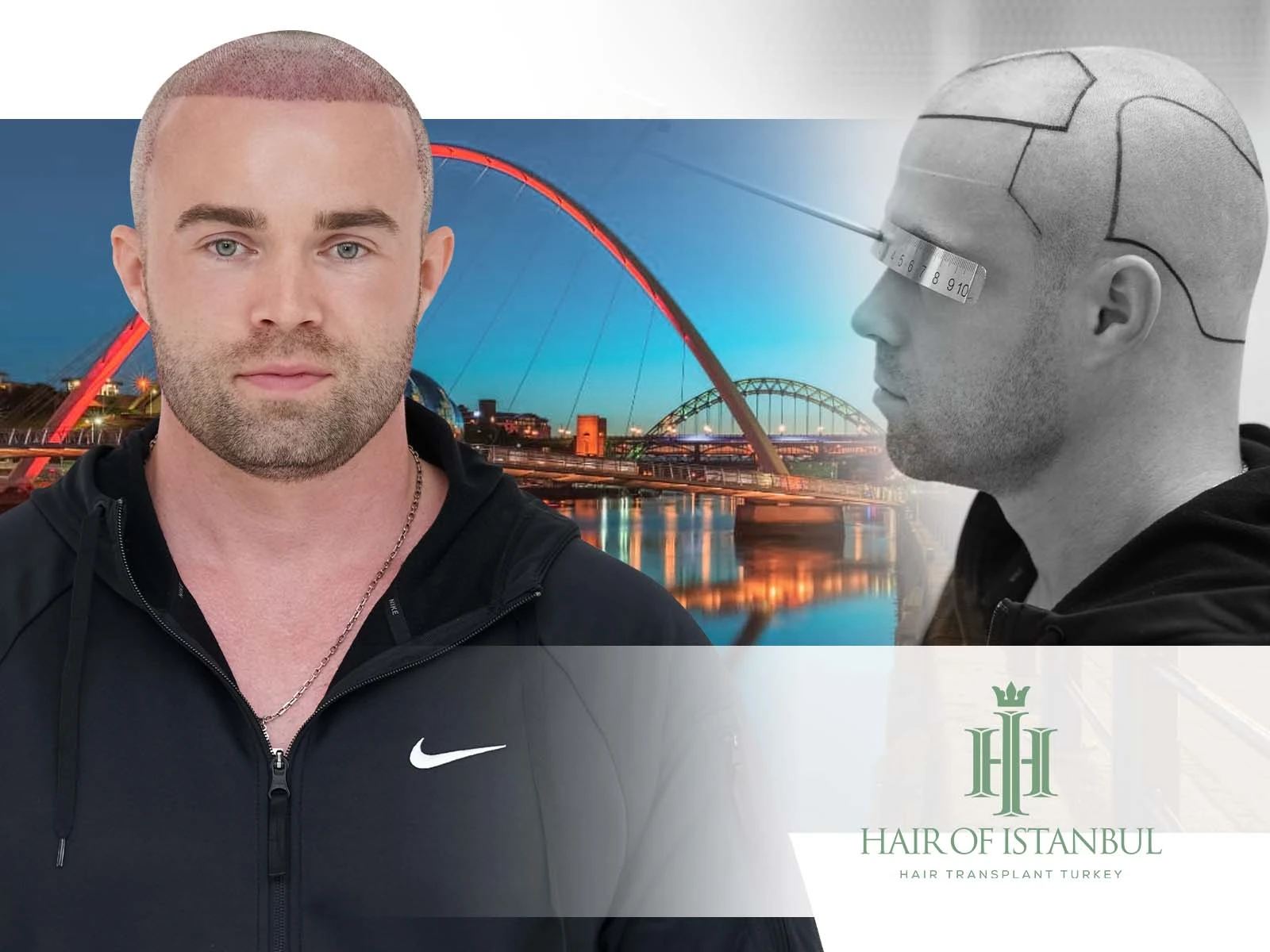 Hair Transplant Newcastle: Discover the Istanbul Advantage