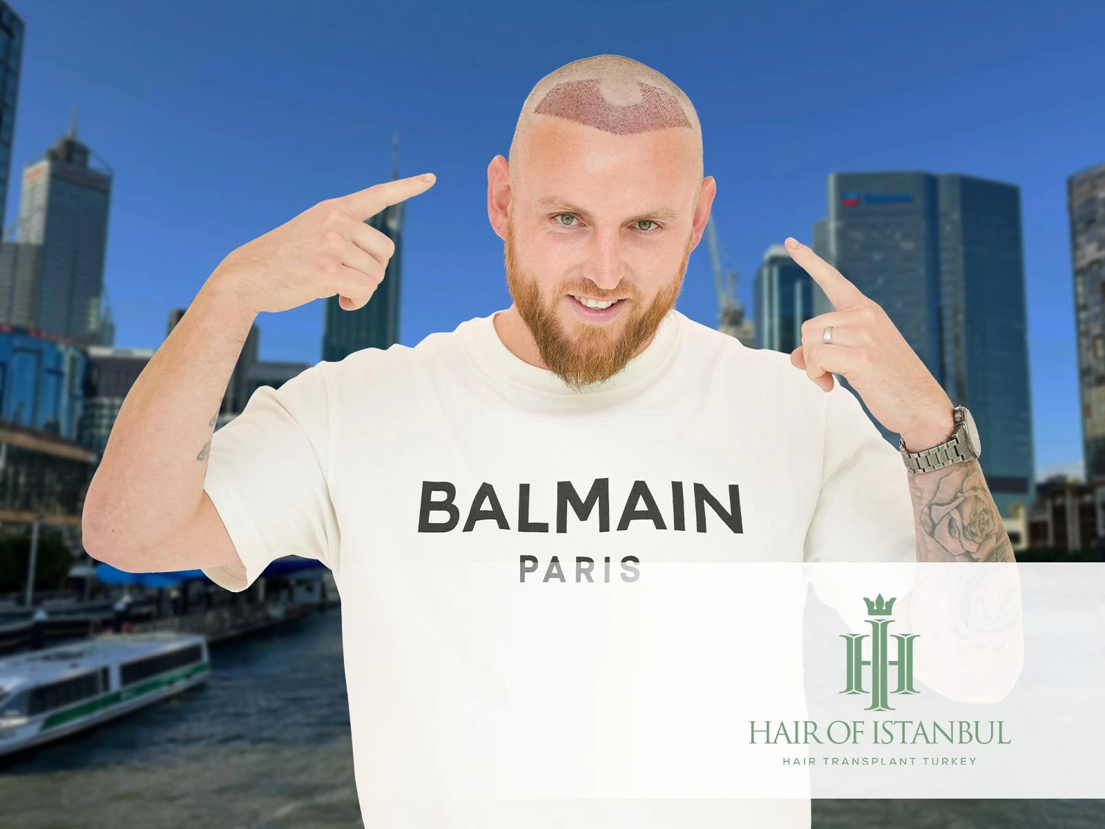 Hair Transplant Perth: Why Istanbul Offers a Superior Alternative