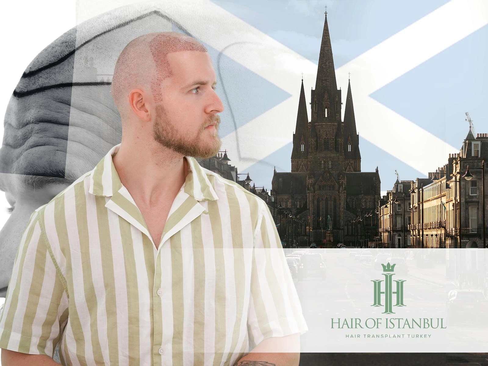 Hair Transplant Scotland vs Istanbul: A Smarter Path to Hair Restoration