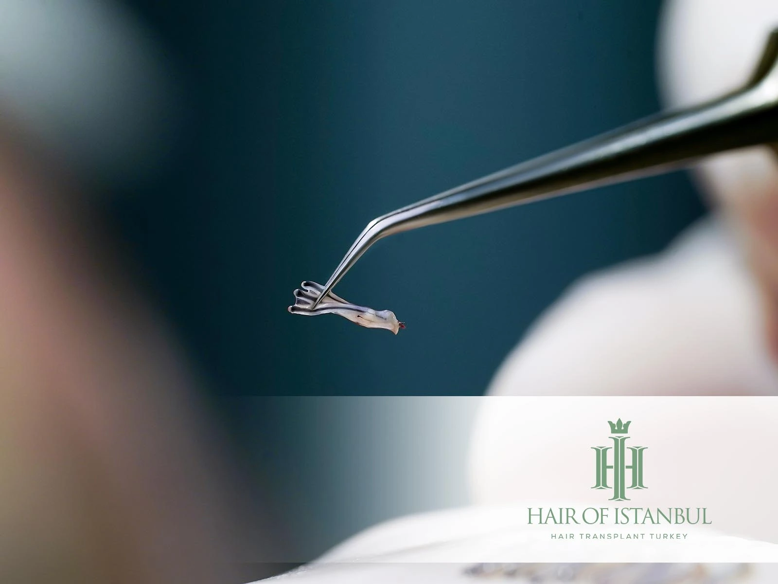 Hair Transplant Surgeons in Turkey: Where Excellence Meets Precision