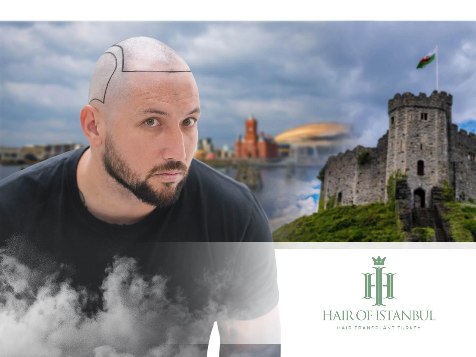 Hair Transplant Surgery Cardiff: Why More People Choose Istanbul Instead