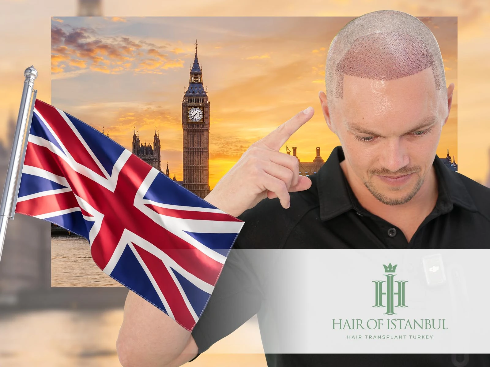 Hair Transplant Surgery in London: What You Need to Know