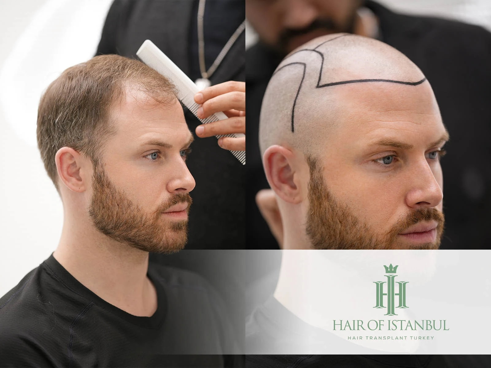 Hair Transplant: The Ultimate Guide to Natural Hair Restoration