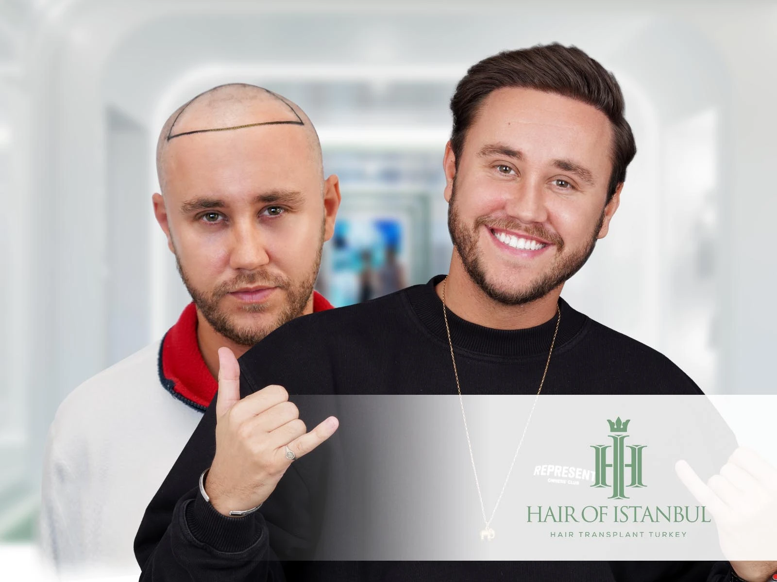 Hair Transplant Turkey Before and After: Real Results You Can Trust