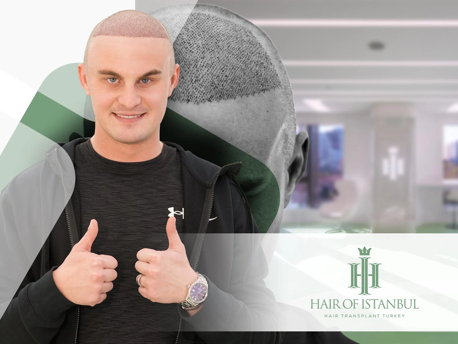 Hair Transplant Turkey Reviews: Why Hair of Istanbul Stands Out