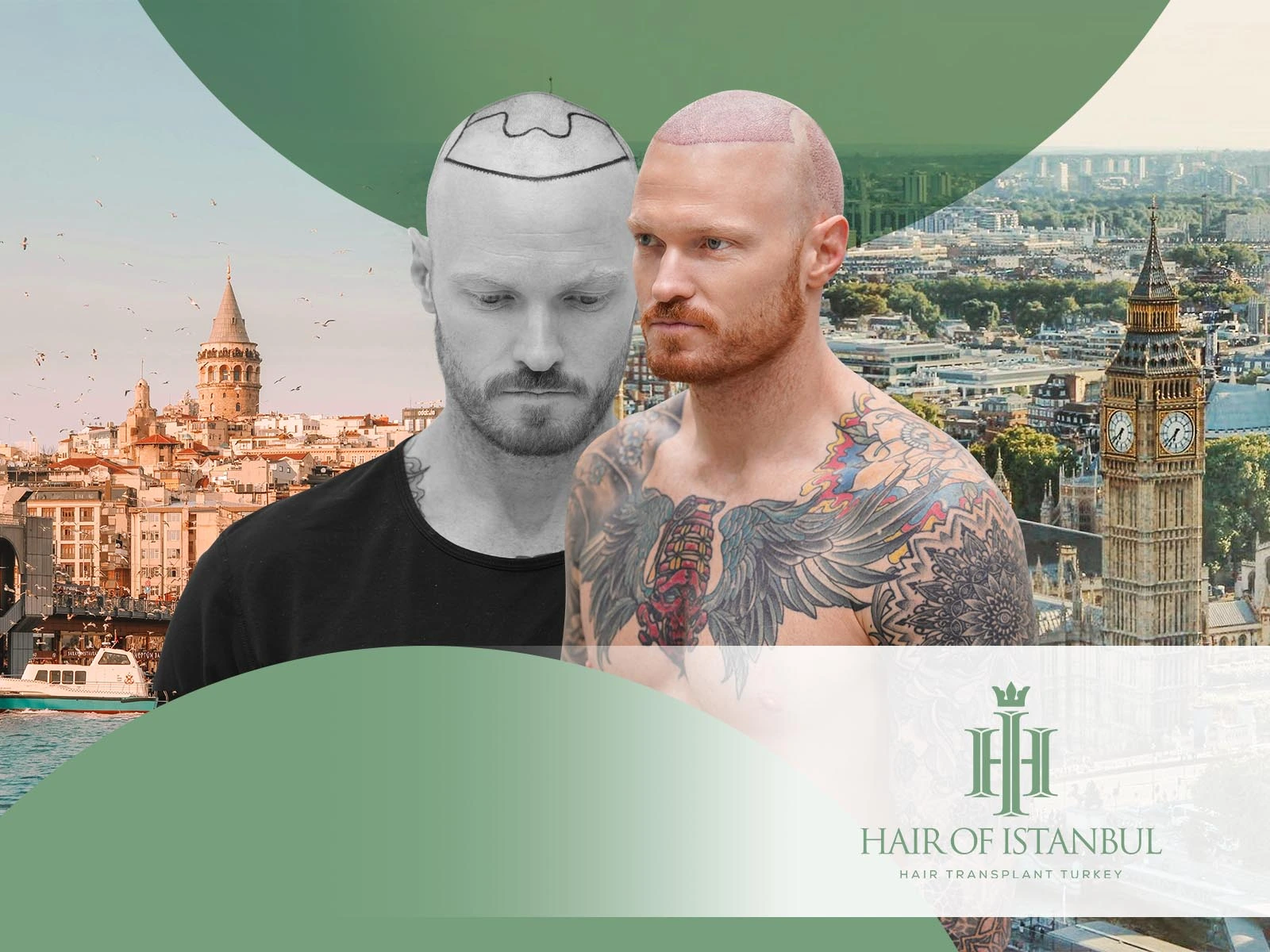 Hair Transplant United Kingdom vs Istanbul: Where Excellence Truly Lies
