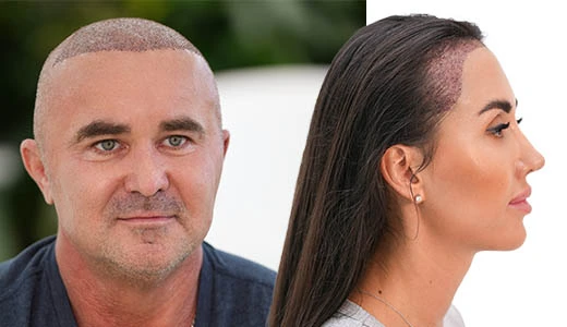 Hair Transplant for All Hair Types and Genders Hair of Istanbul’s Inclusive Approach
