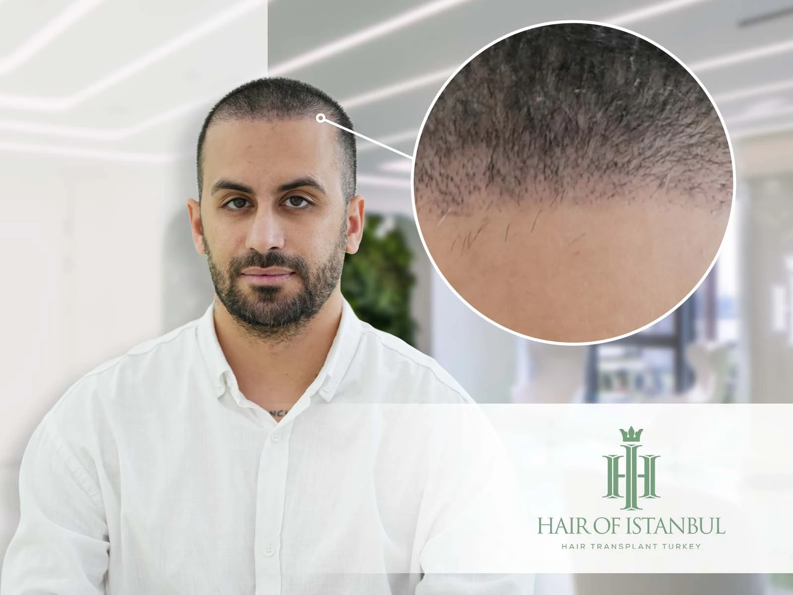 Hair Transplantation After 1 Month: What to Expect in Recovery and Results
