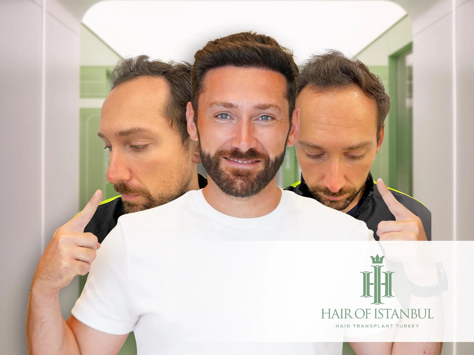 Hair Transplantation: The Complete Guide to Restore Hair Naturally