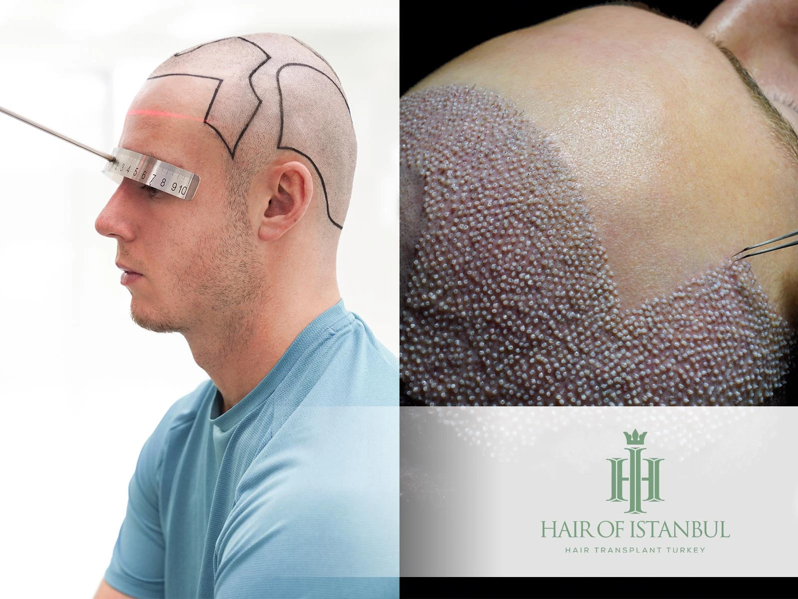 Istanbul Hair Transplant: Natural Results and Trusted Experts