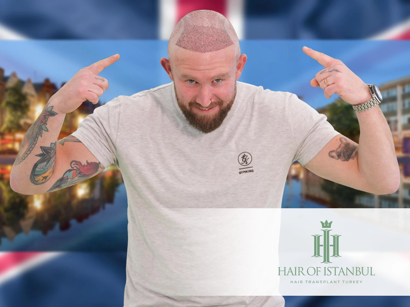 Rethinking Hair Transplant Nottingham: Is Istanbul the Smarter Choice?