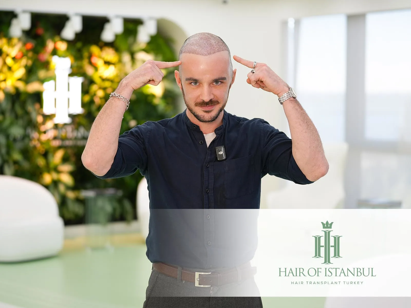 The Gold Standard in Hair Restoration: Finding the Right Hair Transplantation Clinic
