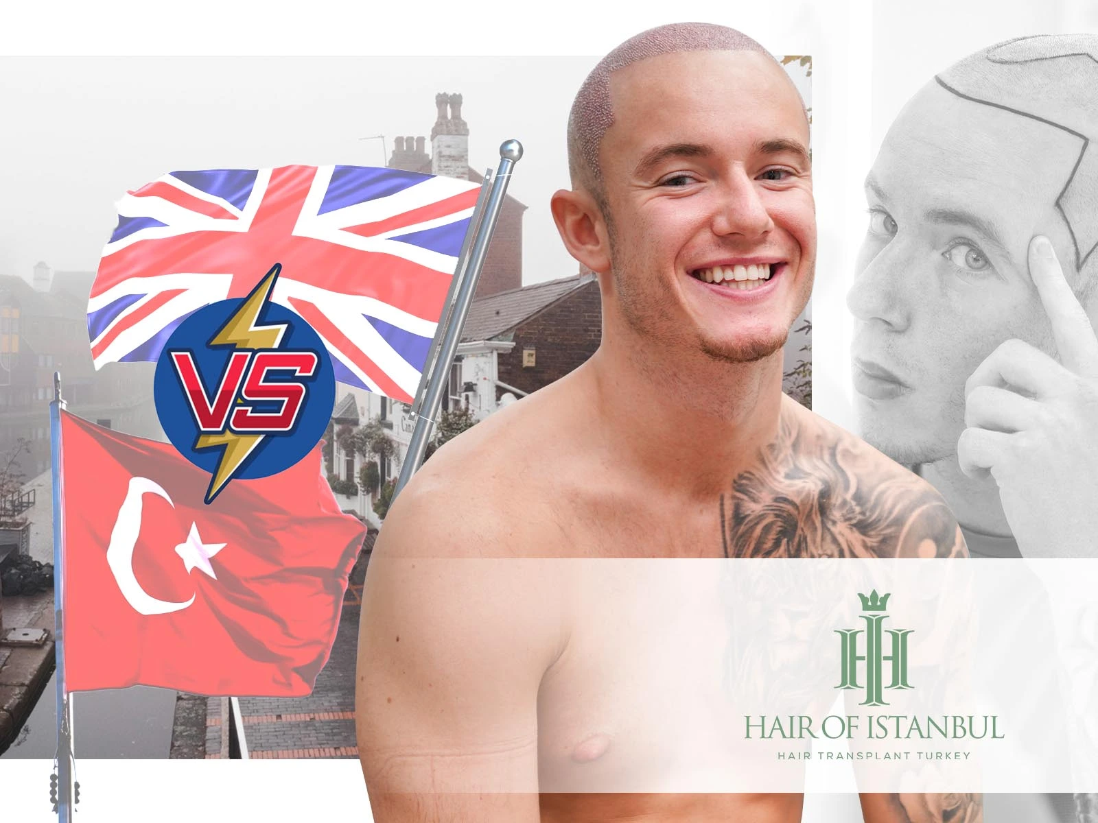 UK Hair Transplant Birmingham: Why Istanbul Is a Smarter Choice