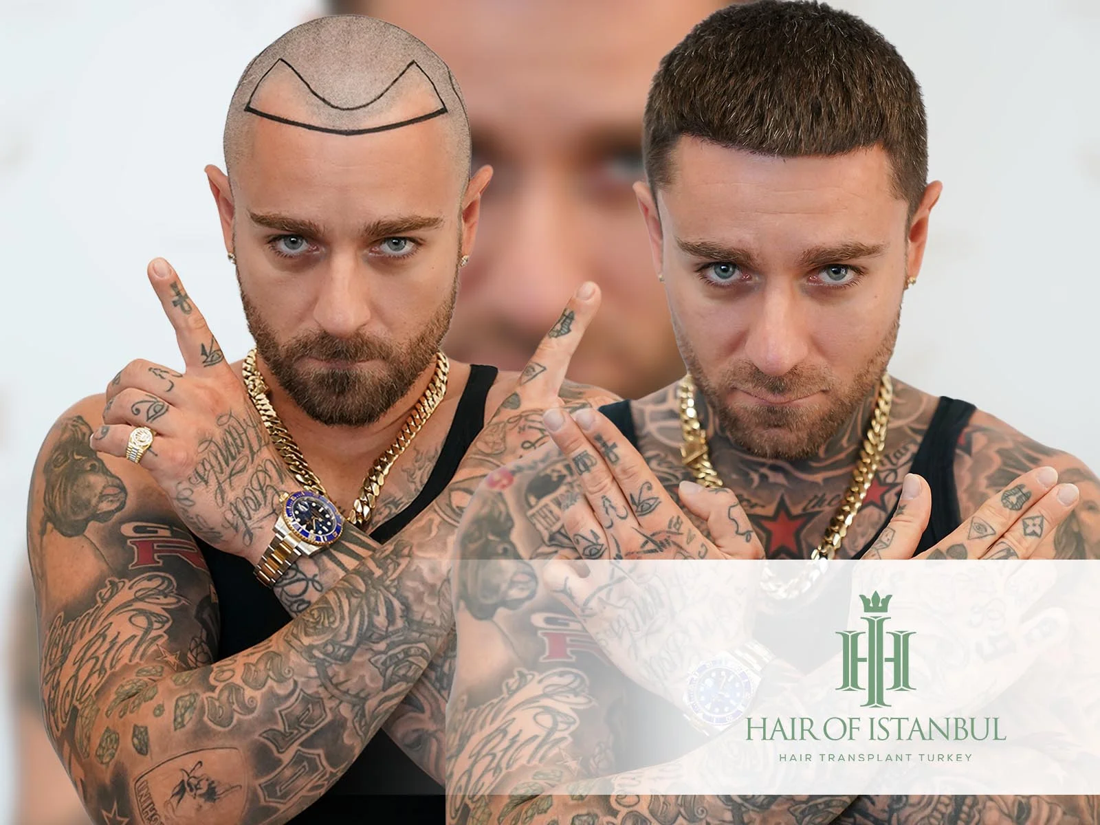 Understanding Hair Implants Cost and What Influences It