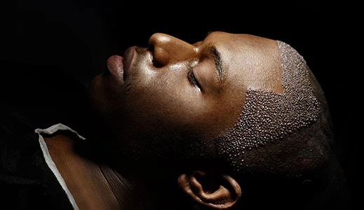 Understanding the Tulsa Hair Transplant Scene