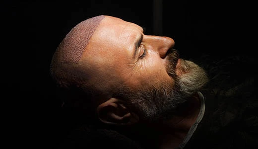 What to Expect During the Hair Transplant Procedure