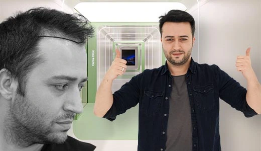 What to Expect from Hair Transplant Leeds Clinics
