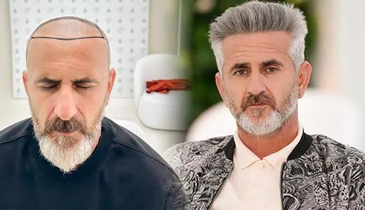 Why Hair of Istanbul Is the Best Choice