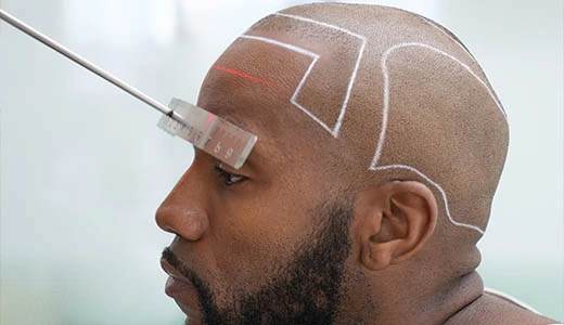 Why Turkey Has Become the Global Leader in Hair Restoration
