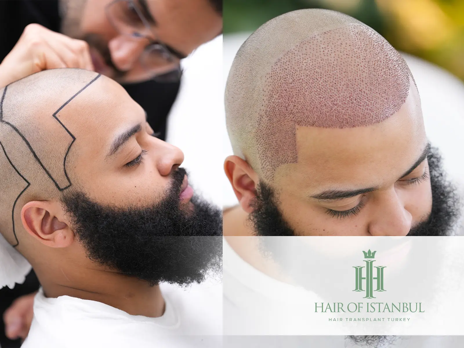 After Hair Transplant Natural Volume Tips for Fuller and Healthier Hair