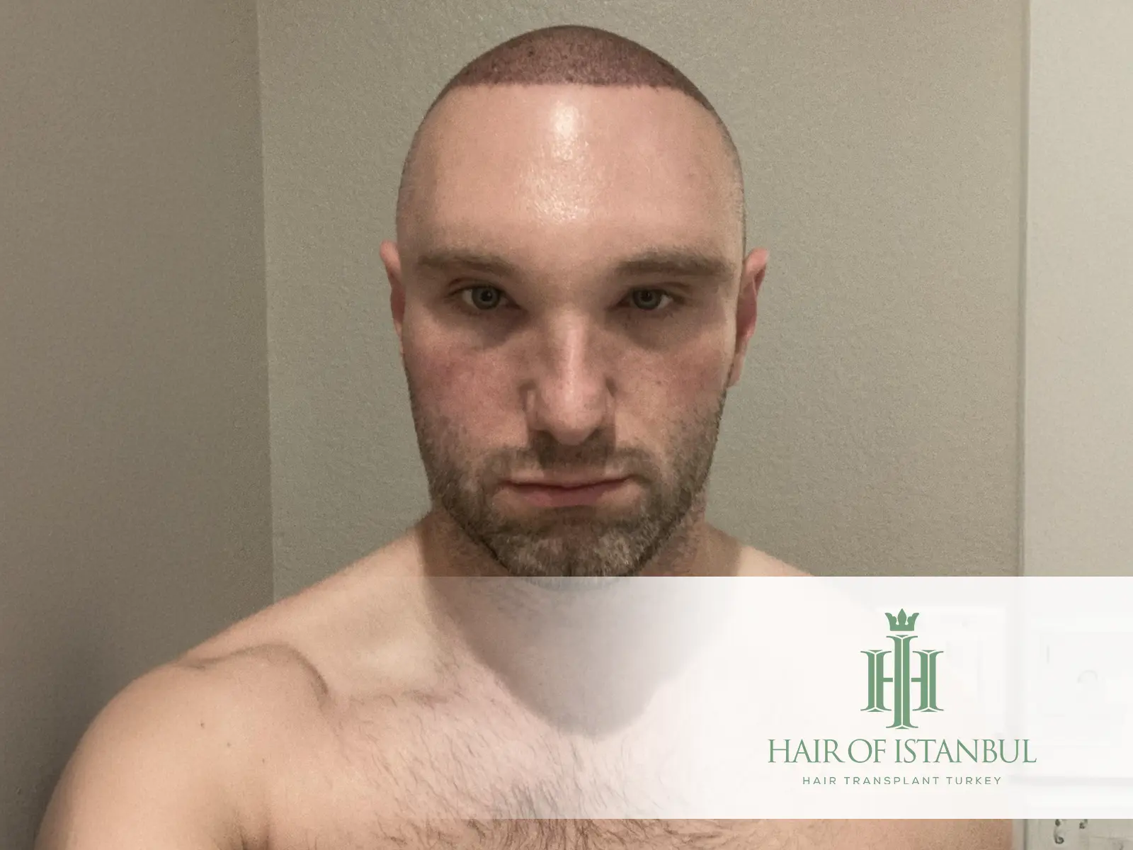 After Hair Transplant Swelling Management: Reduce Discomfort Effectively