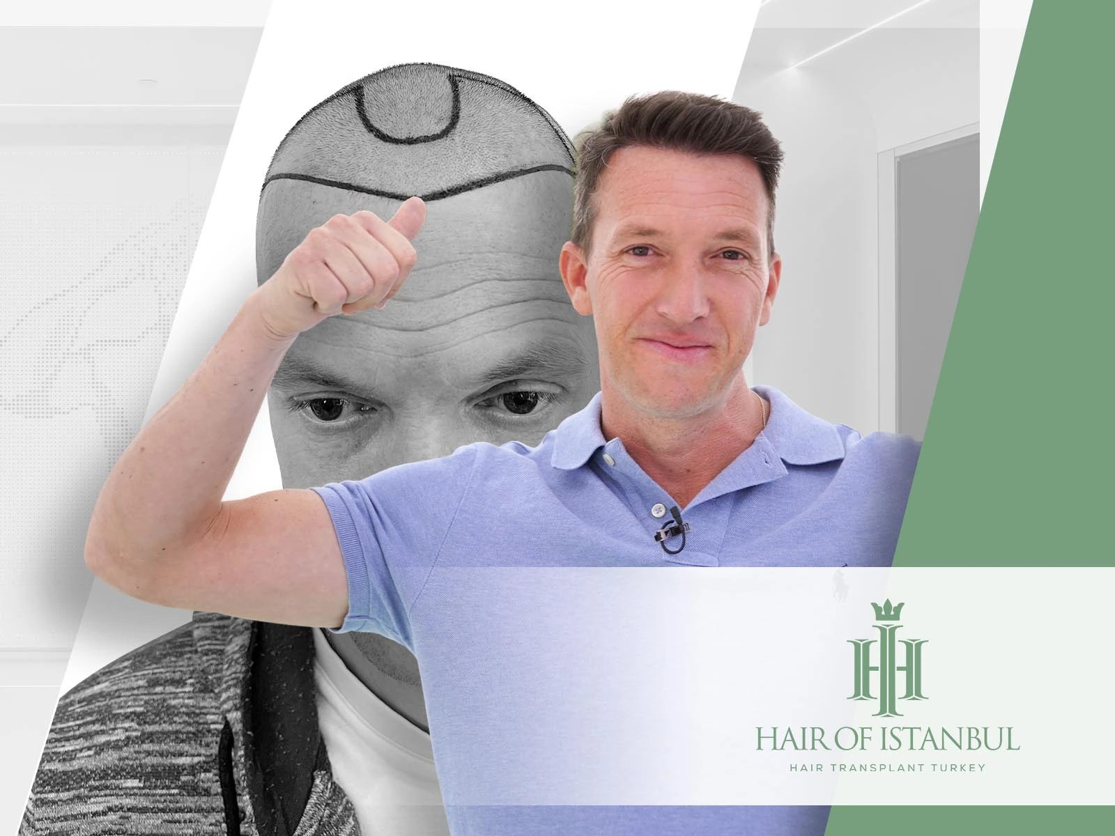 Are Hair Implants Permanent Understanding Lasting Results with Hair of Istanbul