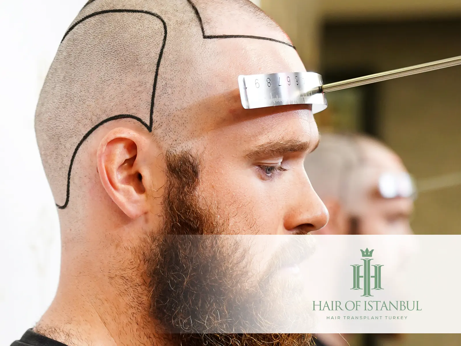 Before Hair Transplant 3D Hairline Analysis: Visualize Your Future Hairline