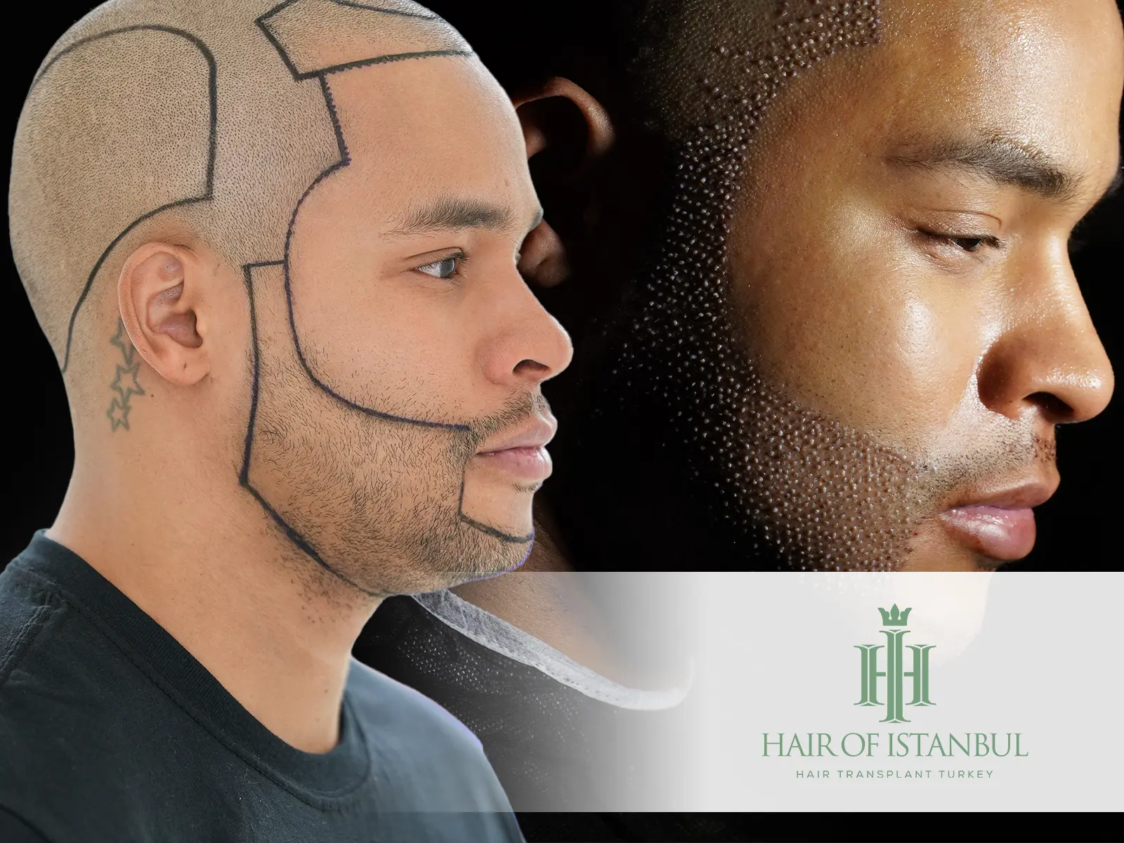Boosting Confidence with Beard Transplant: Restore Your Look, Rebuild Your Self-Esteem