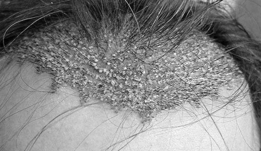 Causes of Bad Hair Implants