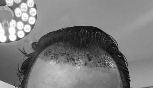 Common Signs of Bad Hair Implants