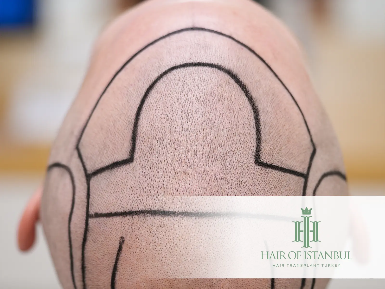Coronal vs Sagittal Incision in Hair Transplant Results: Which Offers Better Visual Outcomes?