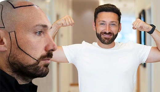 Defining the Best Hair Implants