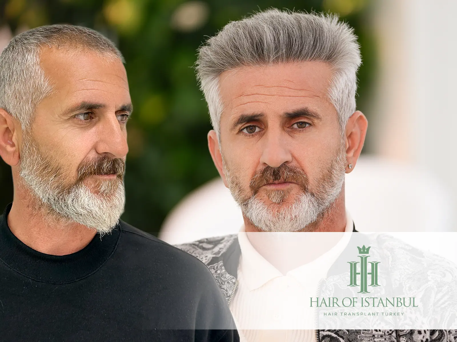 Does Hair Color Change After Hair Transplant?