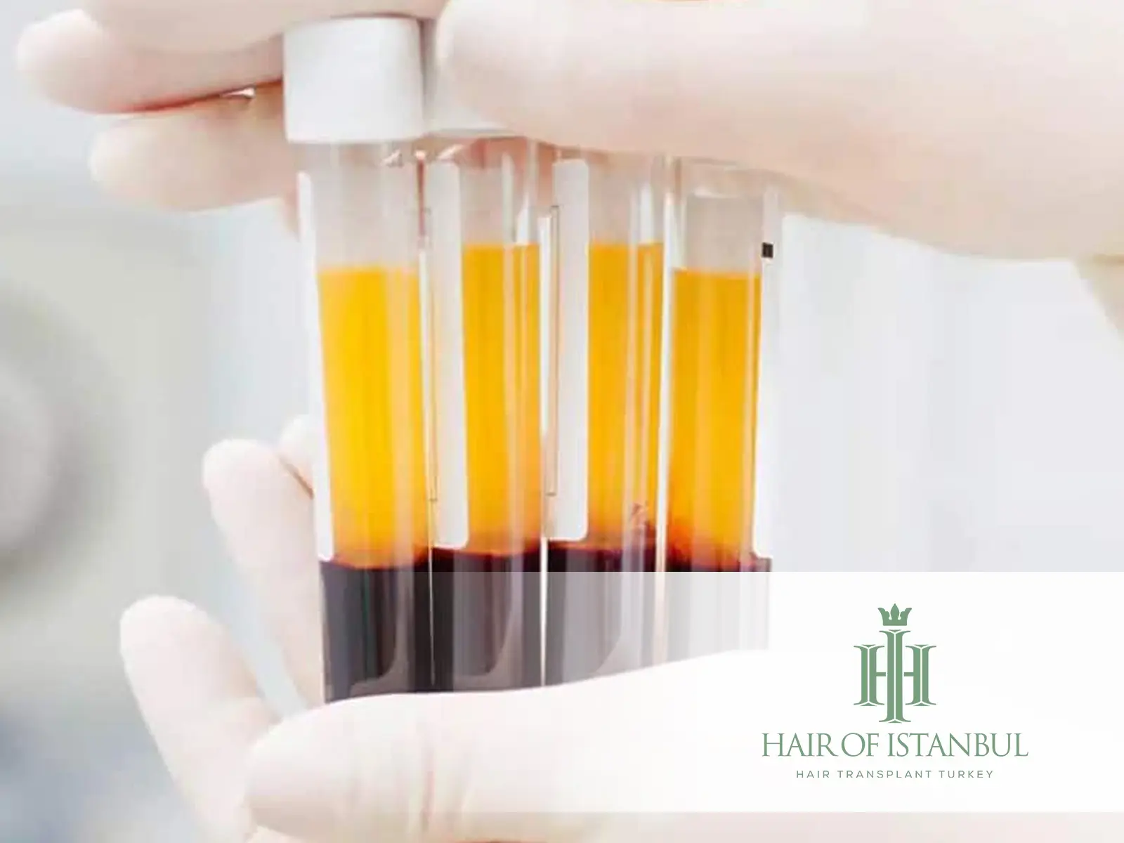 Enhancing Graft Viability with PRF: Natural Support for Hair Transplants