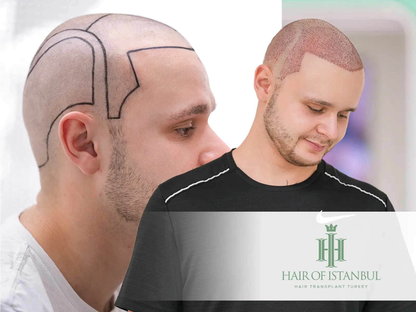 Face Shape and Hairline Design: Aesthetic Harmony in Hair Transplants