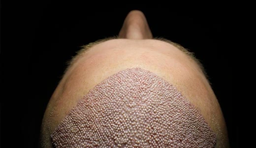 Factors Affecting the Cost of Hair Implants