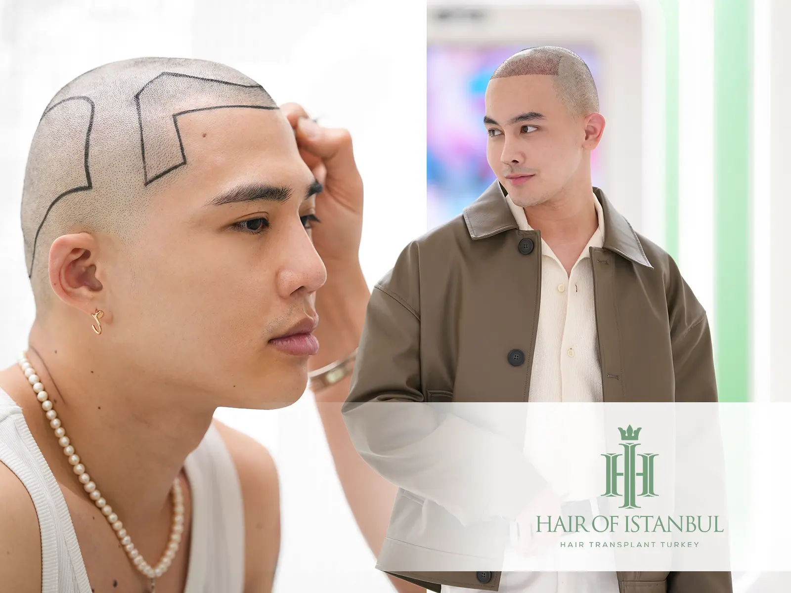 Forehead Reduction Operation: Aesthetic Balance with Personalized Hairline Design