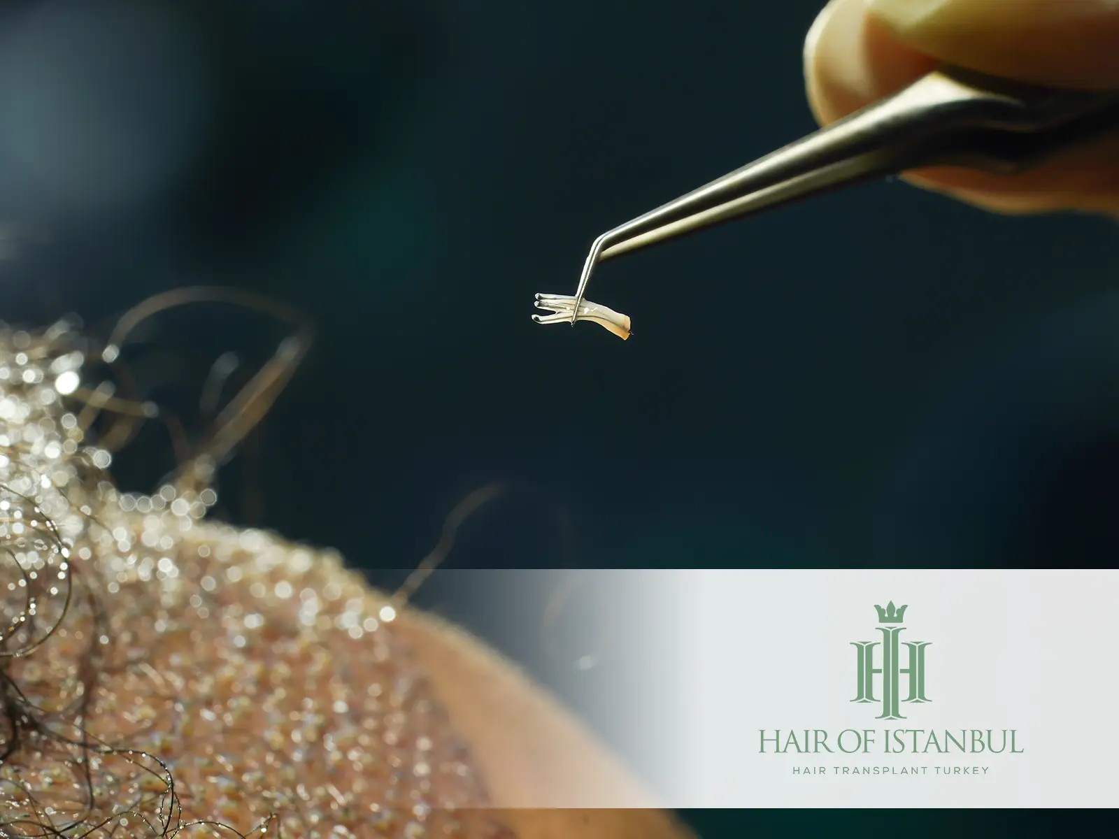 Graft Placement Angle-Direction Matrix: Natural Hair Flow Begins with Design