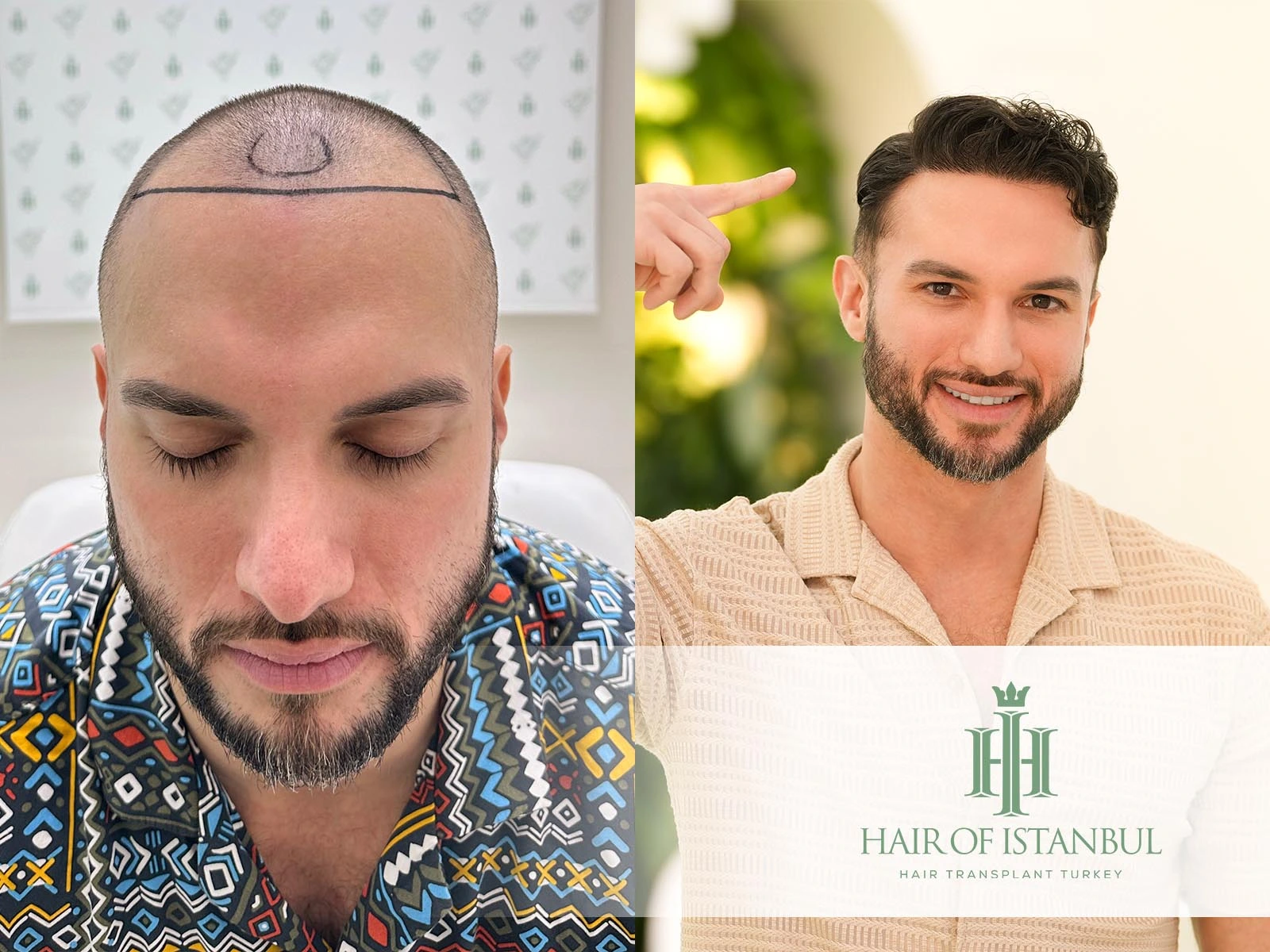 Hair Implant Results That Redefine Confidence And Apperiances