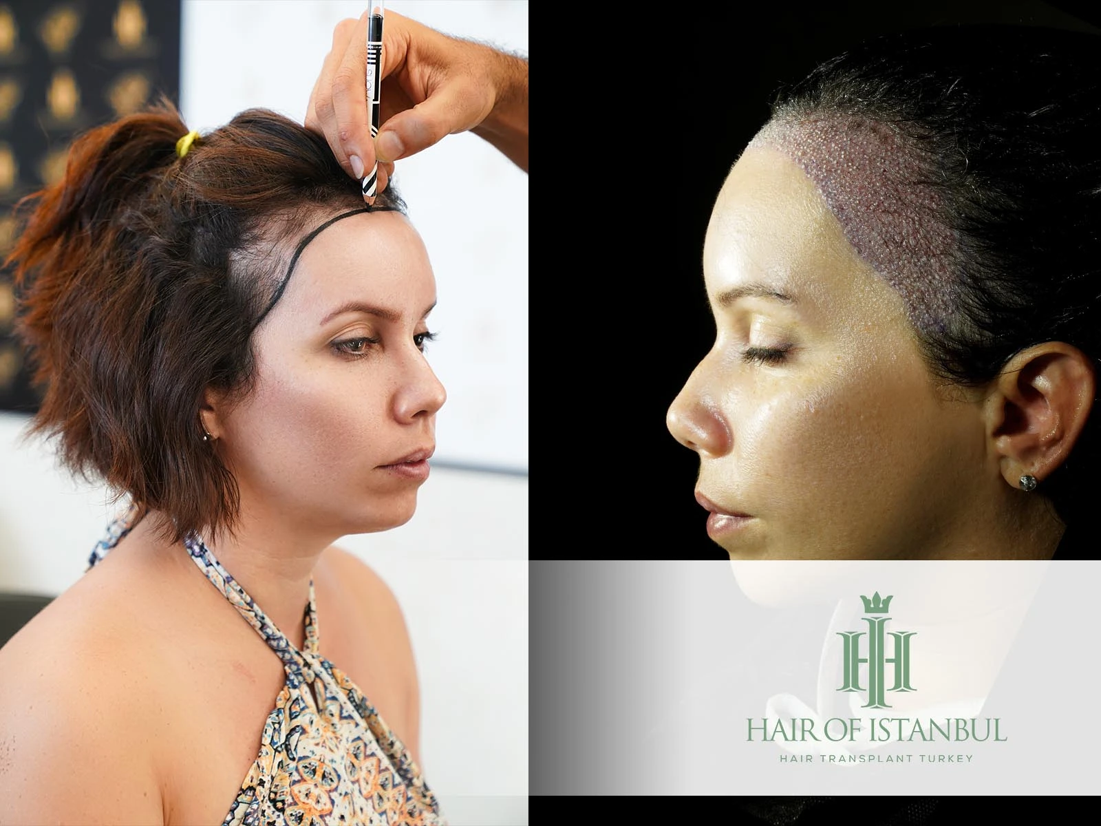 Hair Implant for Ladies Excellence in Turkey