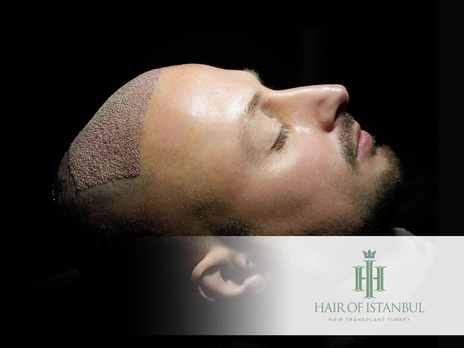 Hair Implantation Side Effects Understanding Risks and Ensuring Success