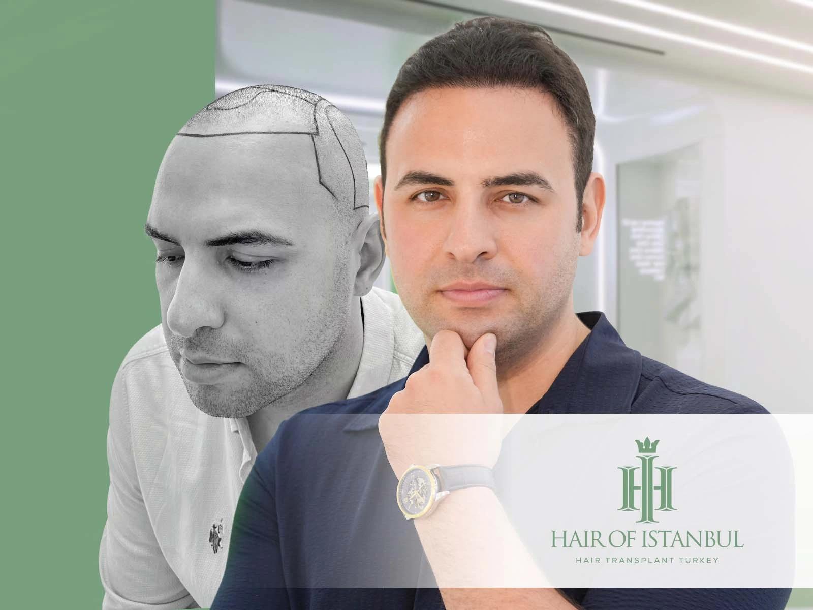 Hair Implants Before and After Pics: Discover Your Future Look