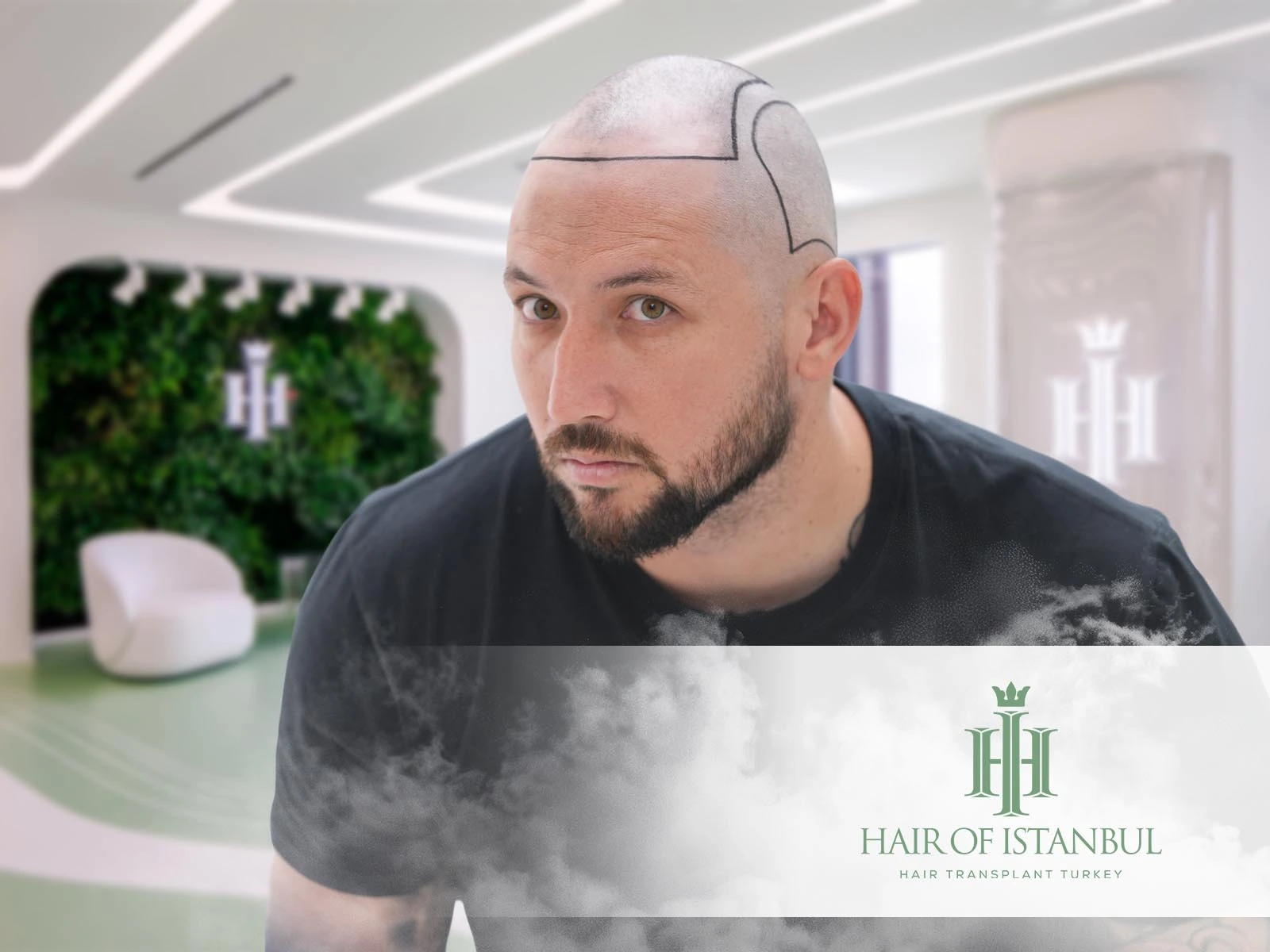 Hair Implants Turkey Istanbul: Discover the Best in Hair Restoration