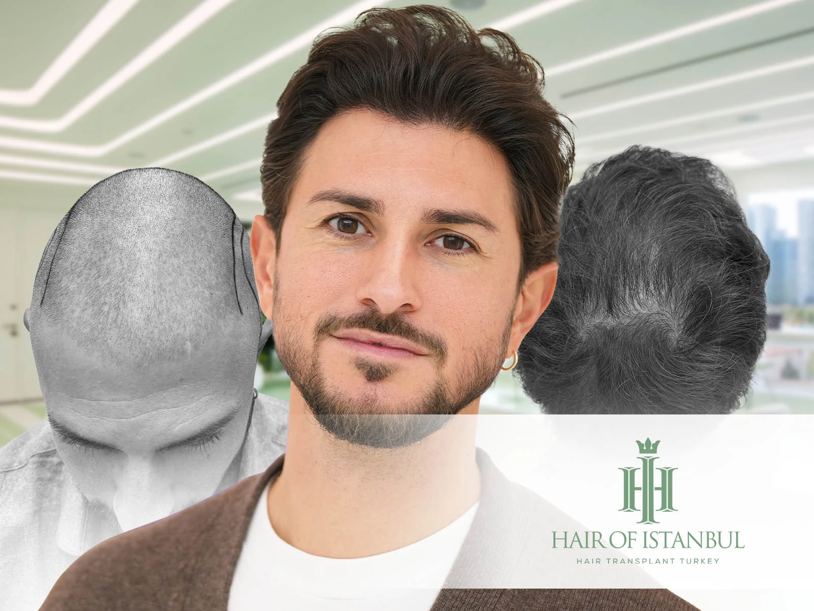 Hair Implants Turkey: The Global Gold Standard in Hair Restoration